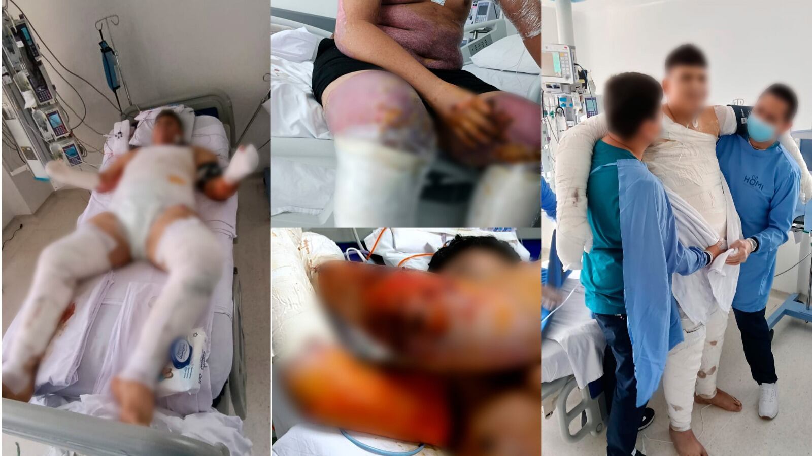 Un joven de 17 años resultó con quemaduras en el 85 por ciento de su cuerpo mientras trabajaba en una atracción turística en Calarcá, Quindío.