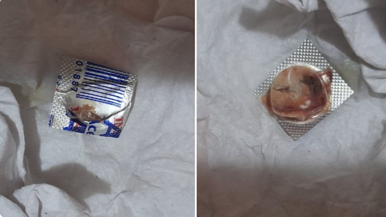 Hombre en Barranquilla duró con el blister de una pastilla en su garganta casi 10 días