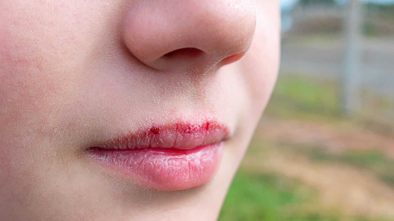 Los labios resecos pueden causar molestias al momento de comer, beber o besar.