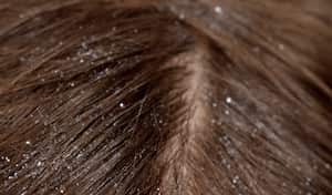 La caspa es un tormento para los hombres y mujeres que la padecen