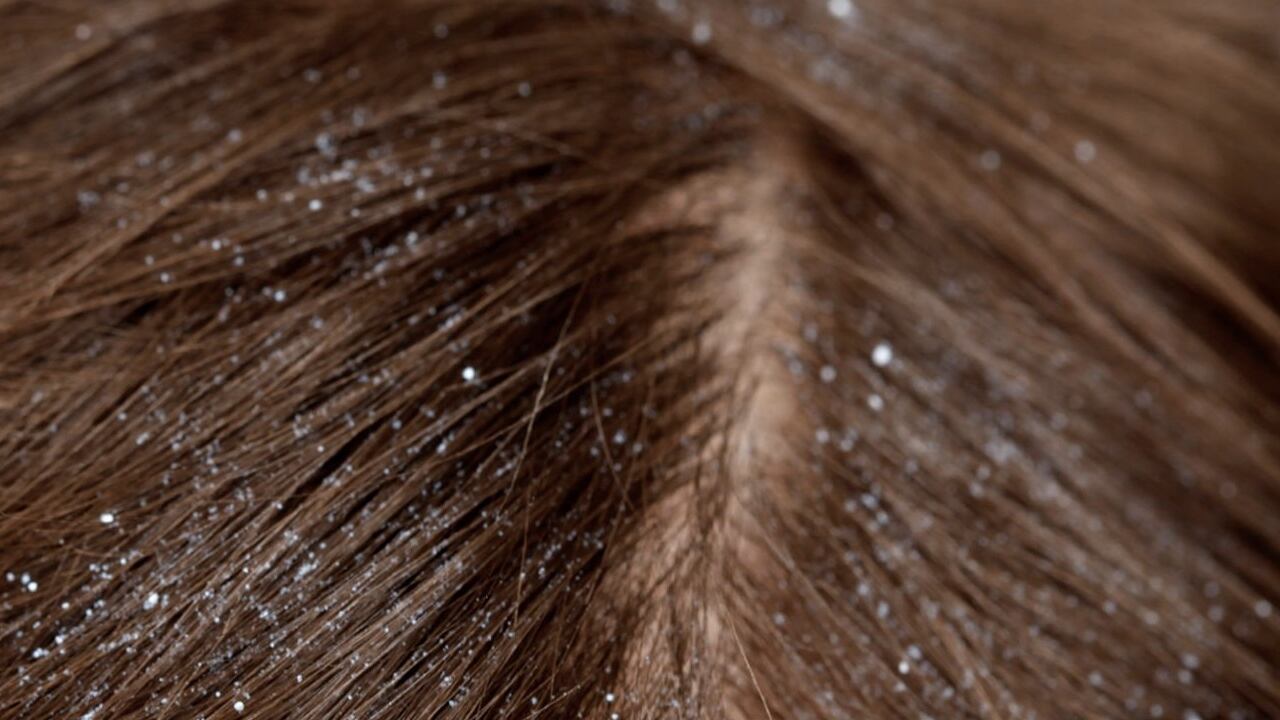 La caspa es un tormento para los hombres y mujeres que la padecen
