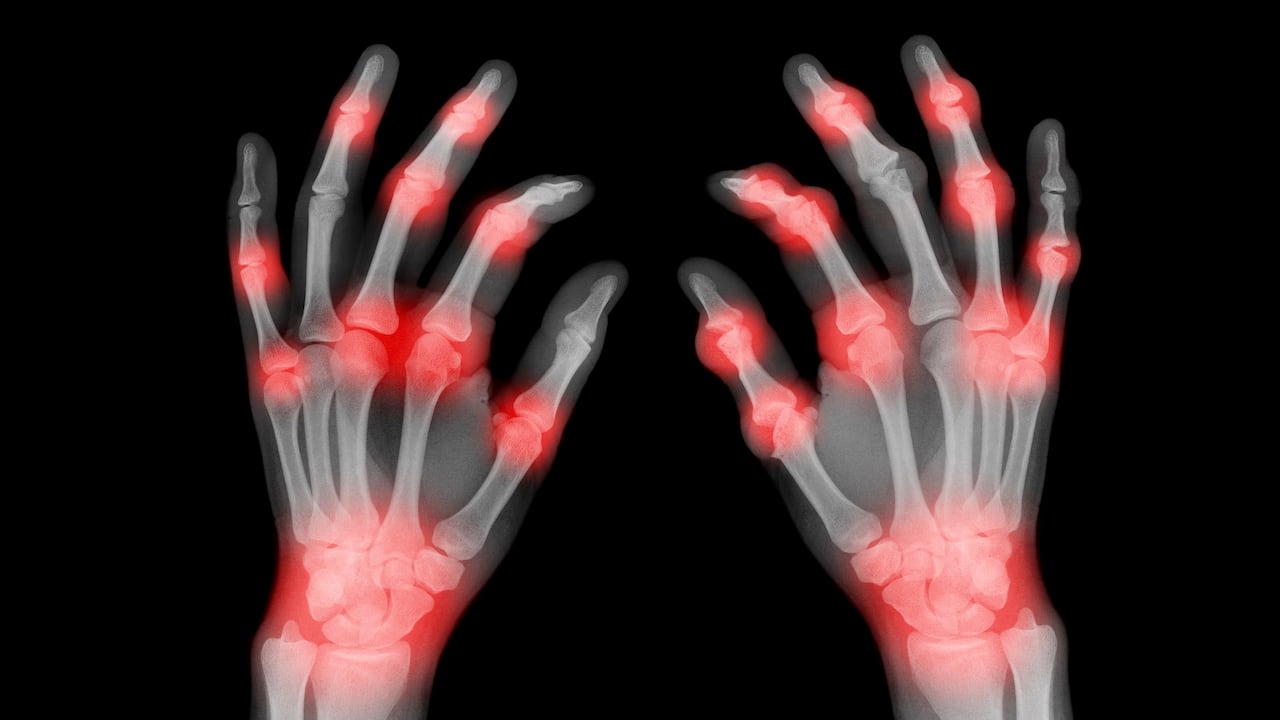 An x-ray of a pair of hands showing painful joints