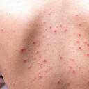 Los adultos también pueden sufrir de acné.