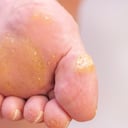 Ojo de pescado - verruga plantar