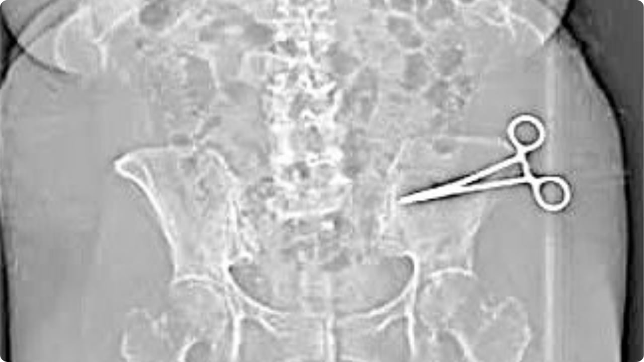 Una tomografía reveló la presencia de unas tijeras quirúrgicas dentro del abdomen de la paciente.