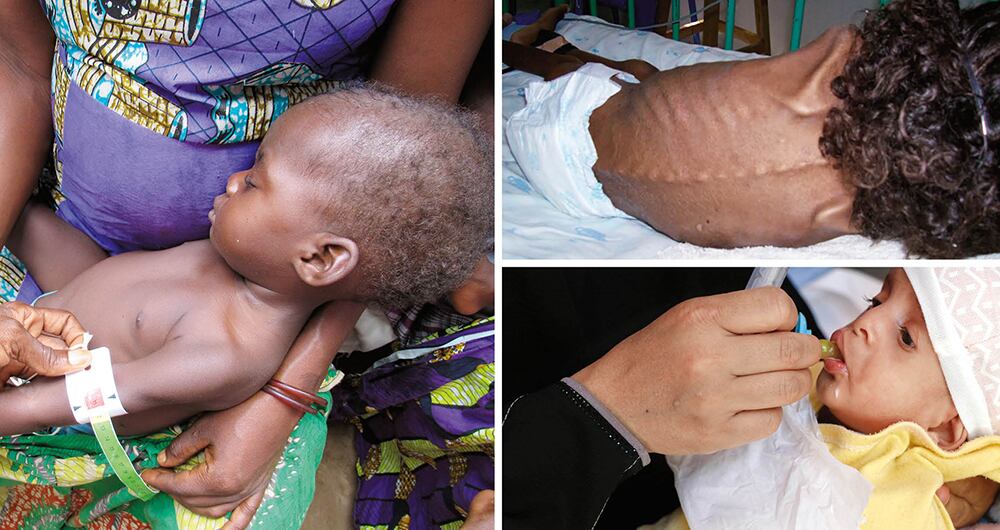 Chocó, La Guajira y Vichada son las zonas del país más afectadas por las muertes relacionadas con desnutrición infantil.