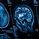 La investigación logró establecer una hoja de ruta para mejorar la atención en ACV en diferentes países.