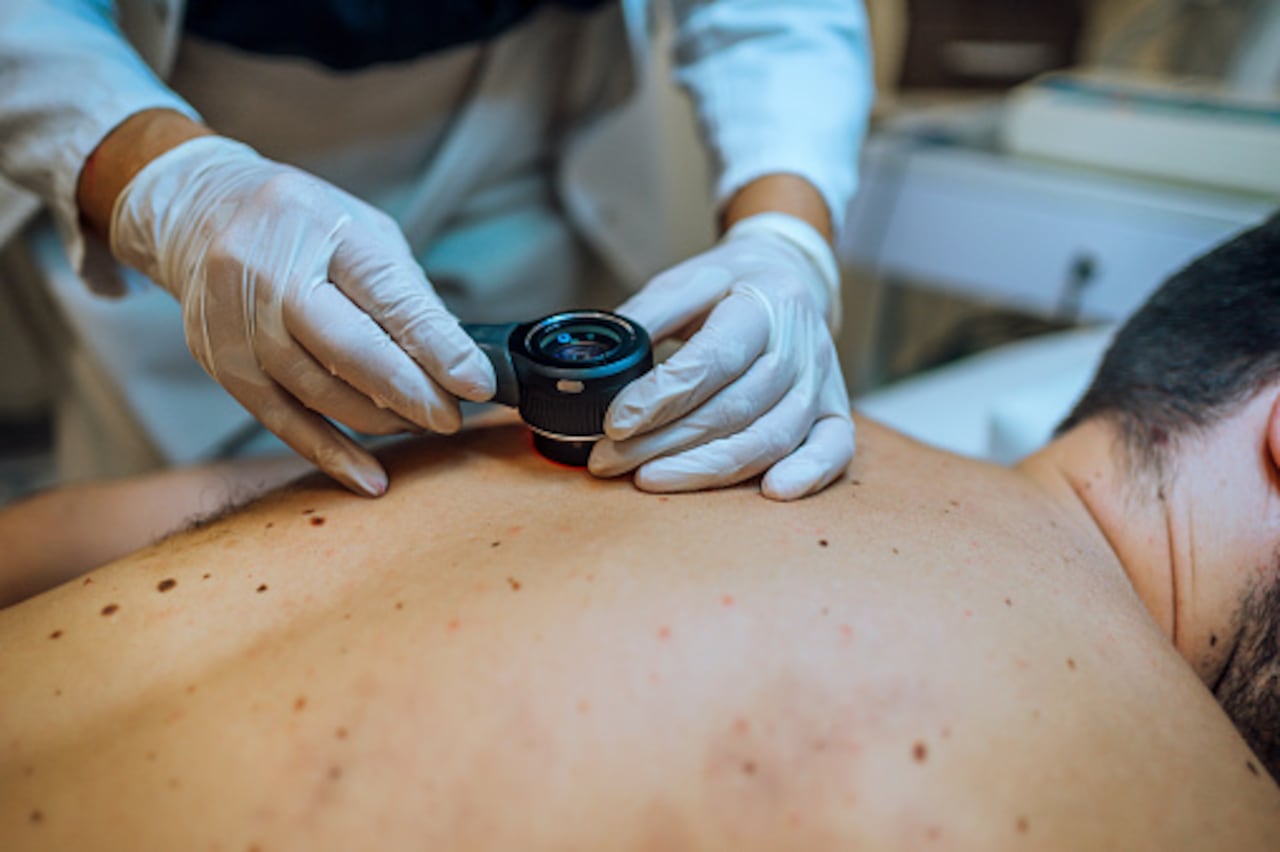 Las manchas rojizas en la piel son un síntoma de cáncer.