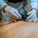 Las manchas rojizas en la piel son un síntoma de cáncer.