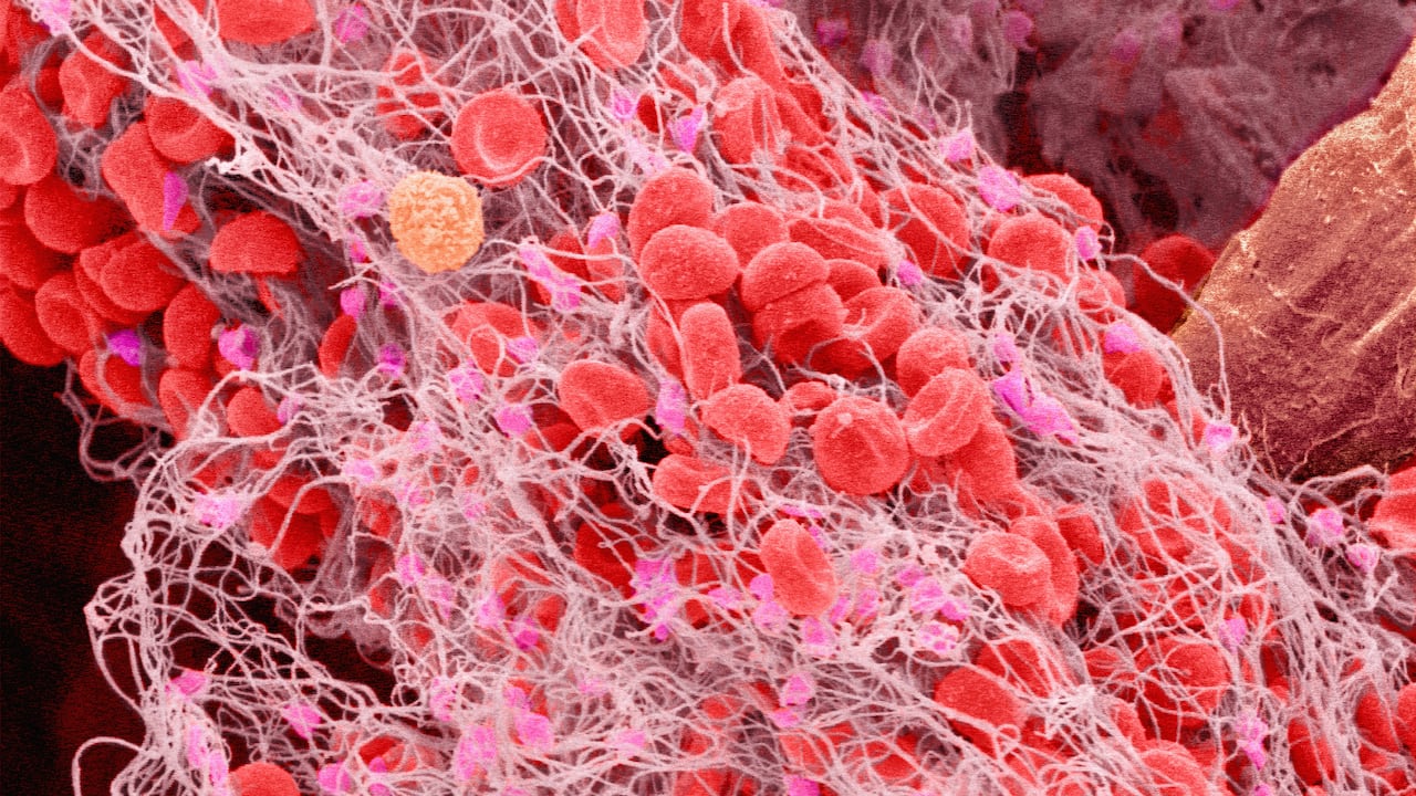 La trombosis si no es tratada con antelación puede causar la muerte de la persona.