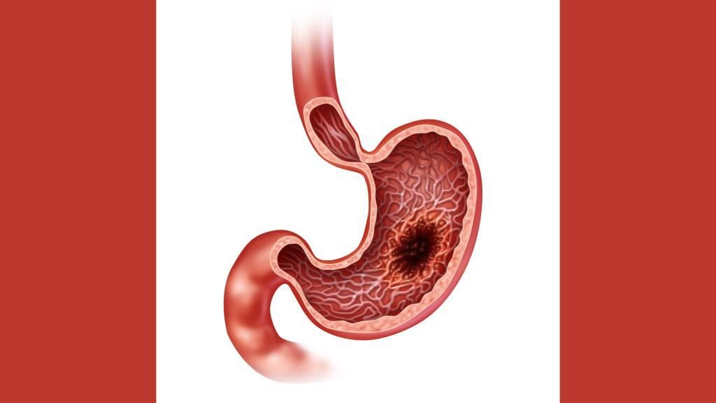 Cáncer de estómago
