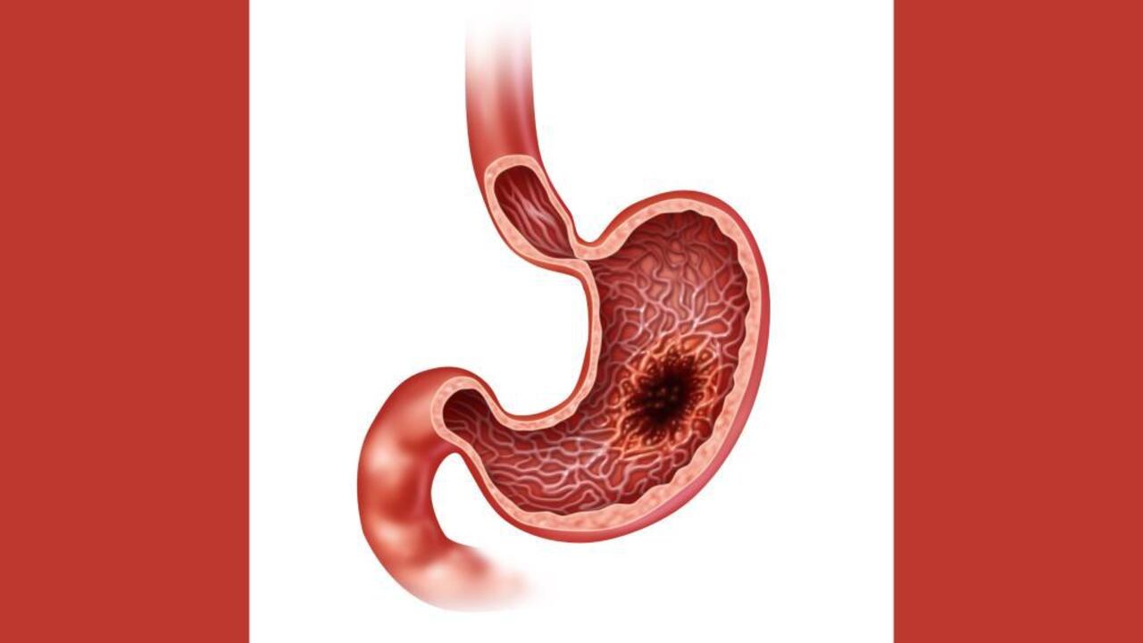 Cáncer de estómago