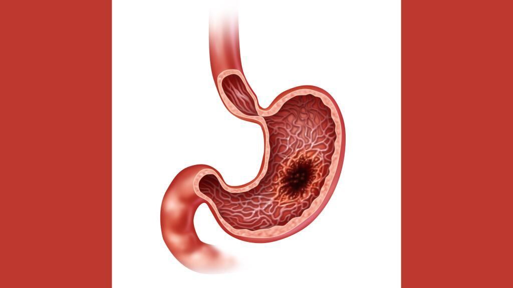 Cáncer de estómago