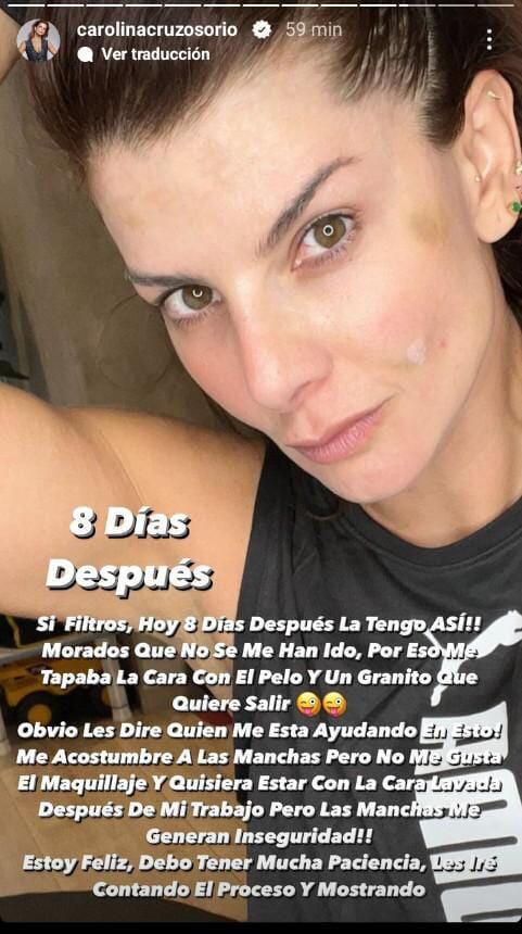 La celebridad mostró las mejoras en su rostro tras un tratamiento.