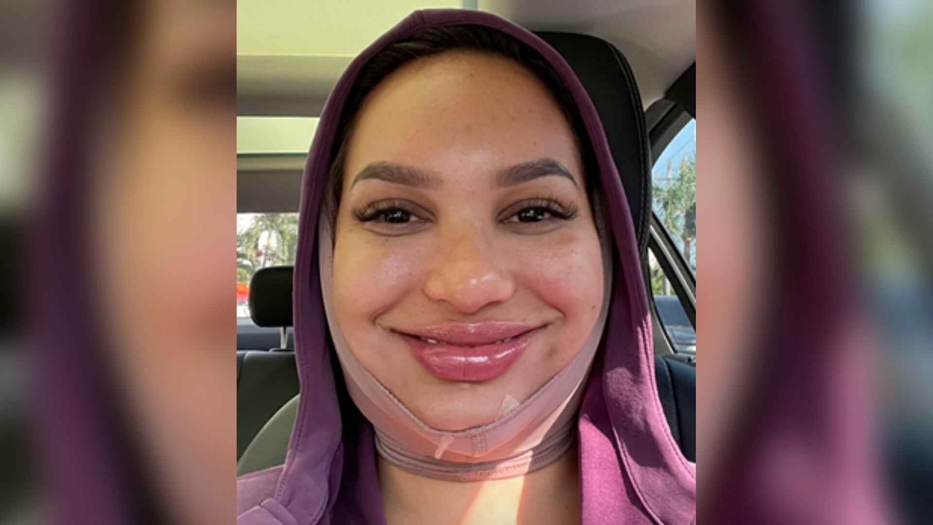 Andrea Valdiri compartió en sus historias de Instagram cómo le había quedado el rostro después de su procedimiento.