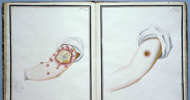 Dibujos a acuarela que muestran la inoculación de viruela.