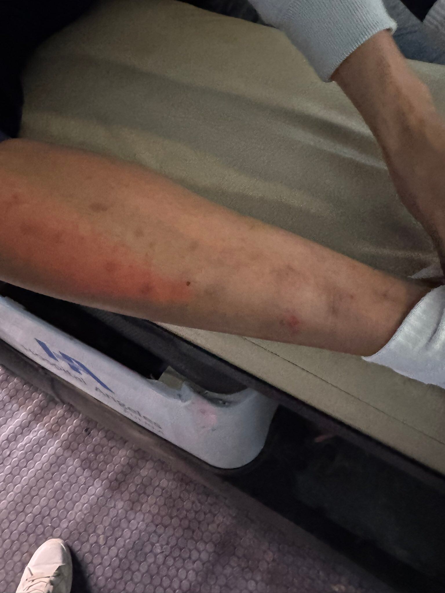 Pierna de Kevin Mier después del partido entre Cruz Azul y Pumas.