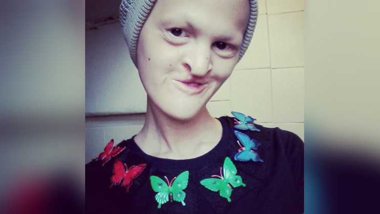 La estadounidense tiene una extraña mutación genética llamada displasia ectodérmica.