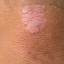 Manchas en la piel que producen picor. A medida que el paciente se rasca, la piel se va liquidificando.