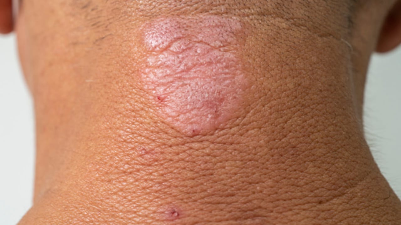 A medida que el paciente se rasca, la piel se va liquidificando.