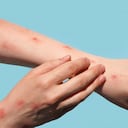 Un simple caso de viruela del mono en un país no endémico es considerado como un brote. Foto: Getty Images