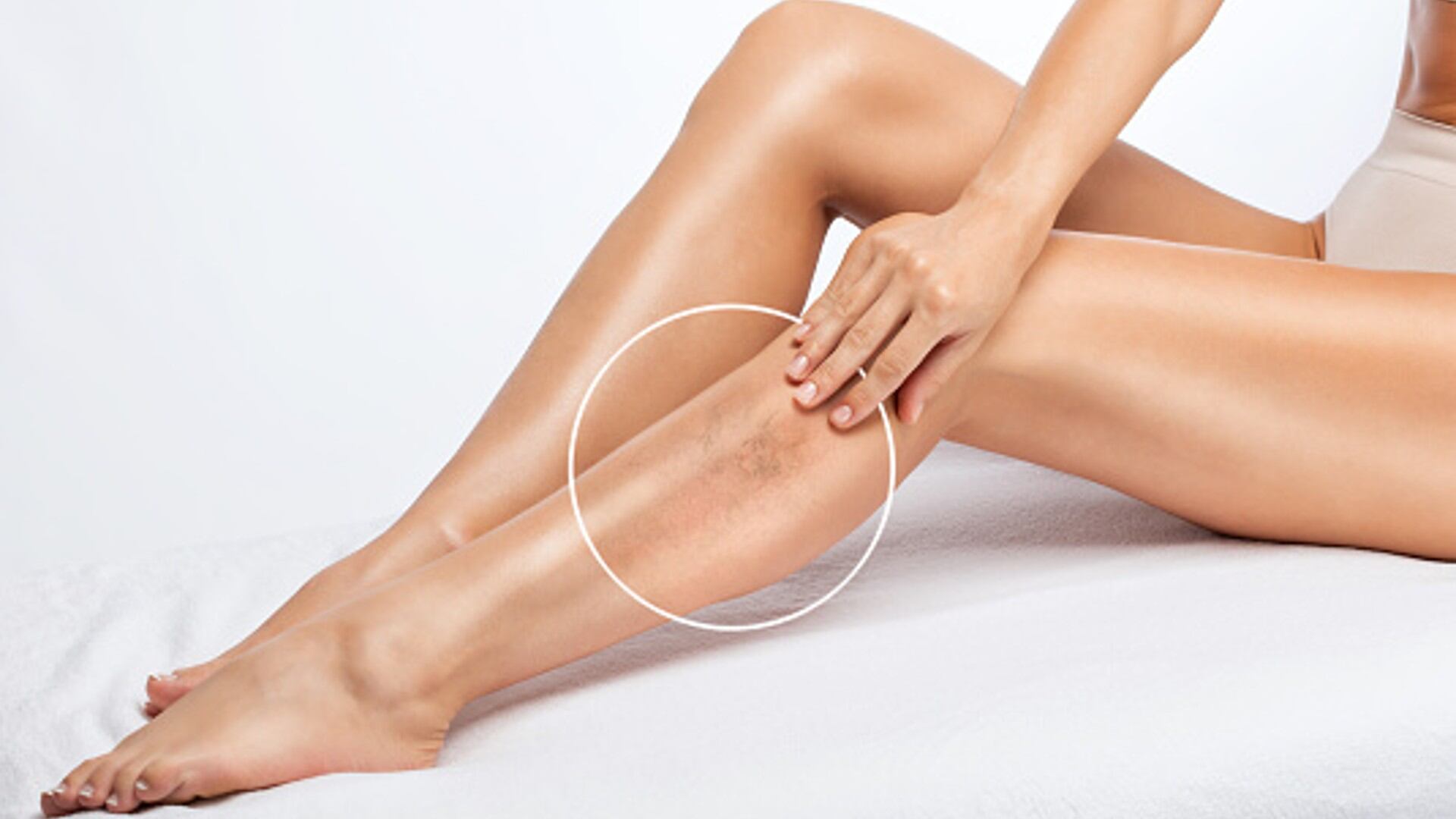 Las varices se producen debido a la insuficiencia venosa es decir, por la incapacidad de las venas de las piernas para ejercer su función de retorno de la sangre hacia el corazón.