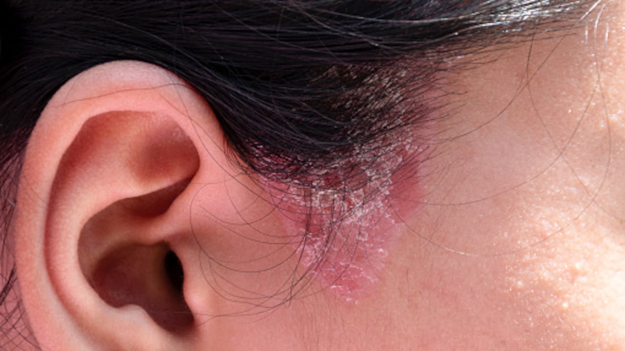 En casos graves, la psoriasis en el cuero cabelludo puede generar sangrado.