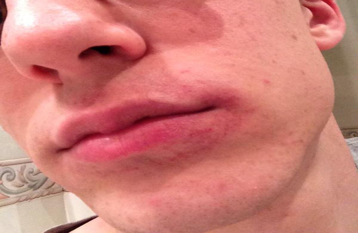 El joven evidencia las marcas alrededor de su boca. 