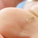 Hay varios tipos de verrugas que pueden aparecer en cualquier parte del cuerpo.