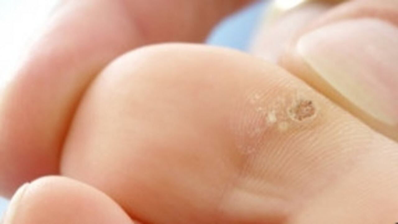 Hay varios tipos de verrugas que pueden aparecer en cualquier parte del cuerpo.