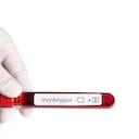 Viruela del mono - Foto de referencia