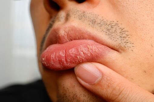 un mal trato puede hacerlos lucir los labios secos.