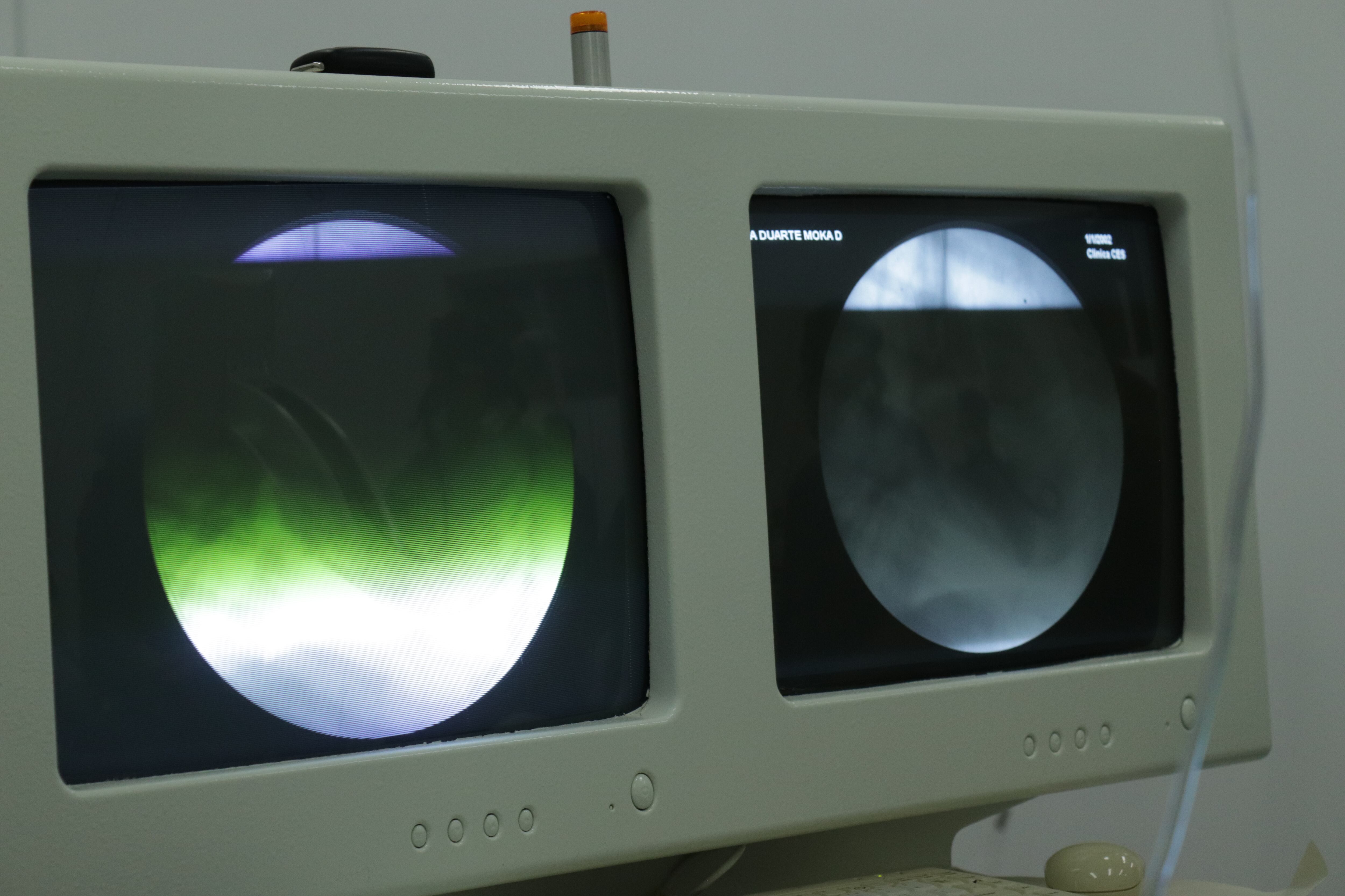 El procedimiento se conoce como valvuloplastia pulmonar.