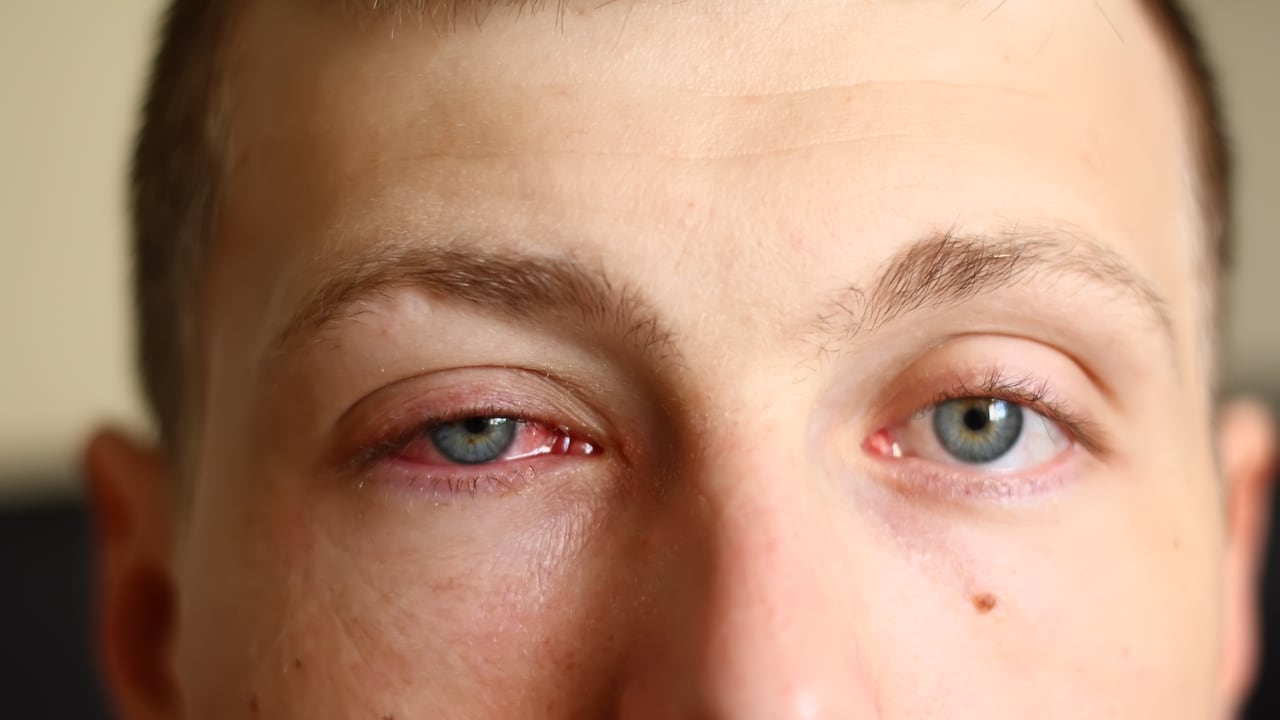 Si la secreción es abundante podría hacer que los párpados se peguen al despertarse y se transmite por tocar los ojos con las manos sucias.