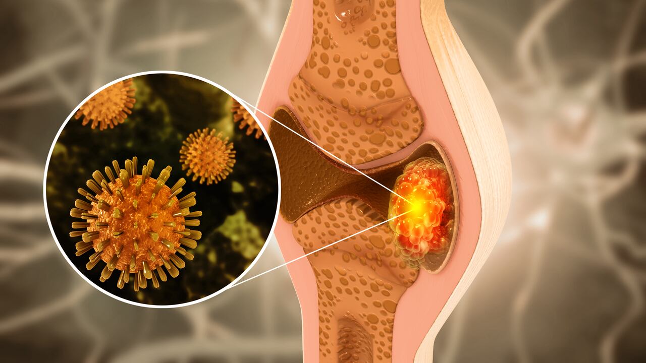 Cáncer de hueso, ilustración en 3D.