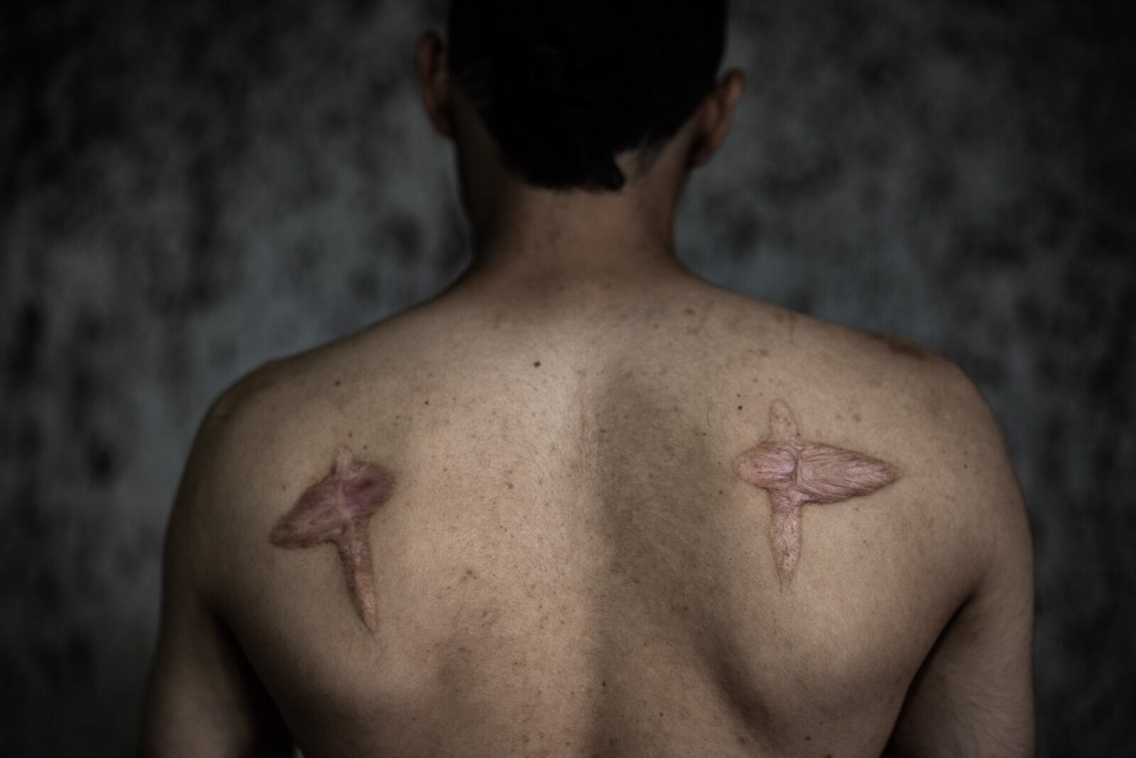 Así le quedó la piel a algunos integrantes de Los Carneros.