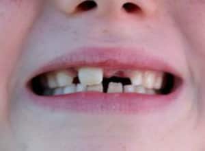 El aceite de coco logró atacar las bacterias responsables de la placa dental.