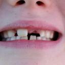 El aceite de coco logró atacar las bacterias responsables de la placa dental.