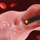 Eliminación de pólipos de colon. Endoscopio dentro de la colonoscopia para la búsqueda de pólipos en el colon. procesamiento 3d