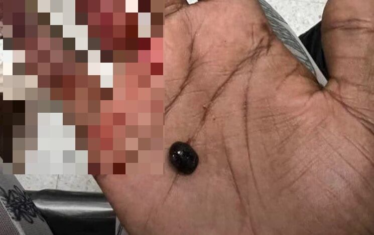 Este es el proyectil que la hirió en el cuello.