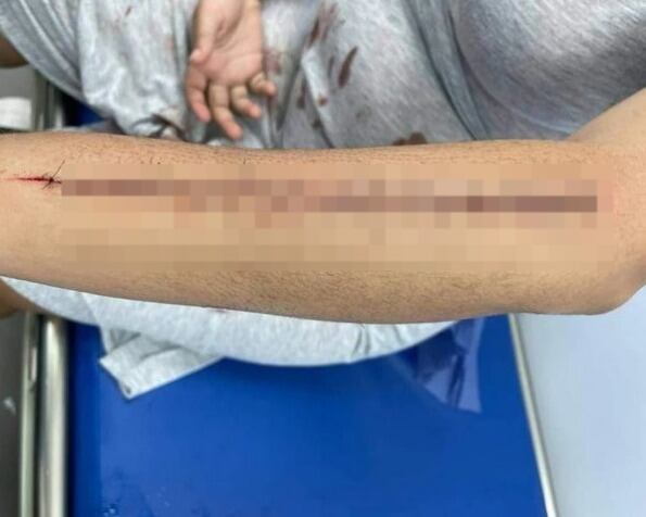 La herida de la joven en todo su brazo con arma cortopunzante