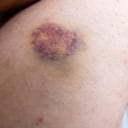 trombocitopenia inmunitaria