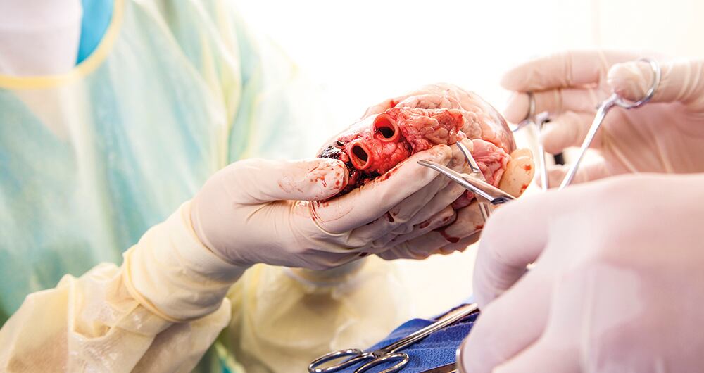 Los trasplantes van en aumento en Colombia
