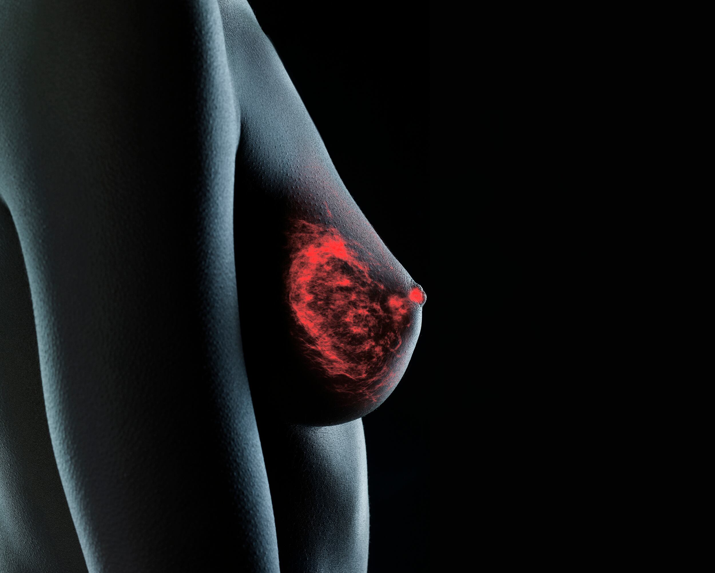 Monograma - Cáncer de seno