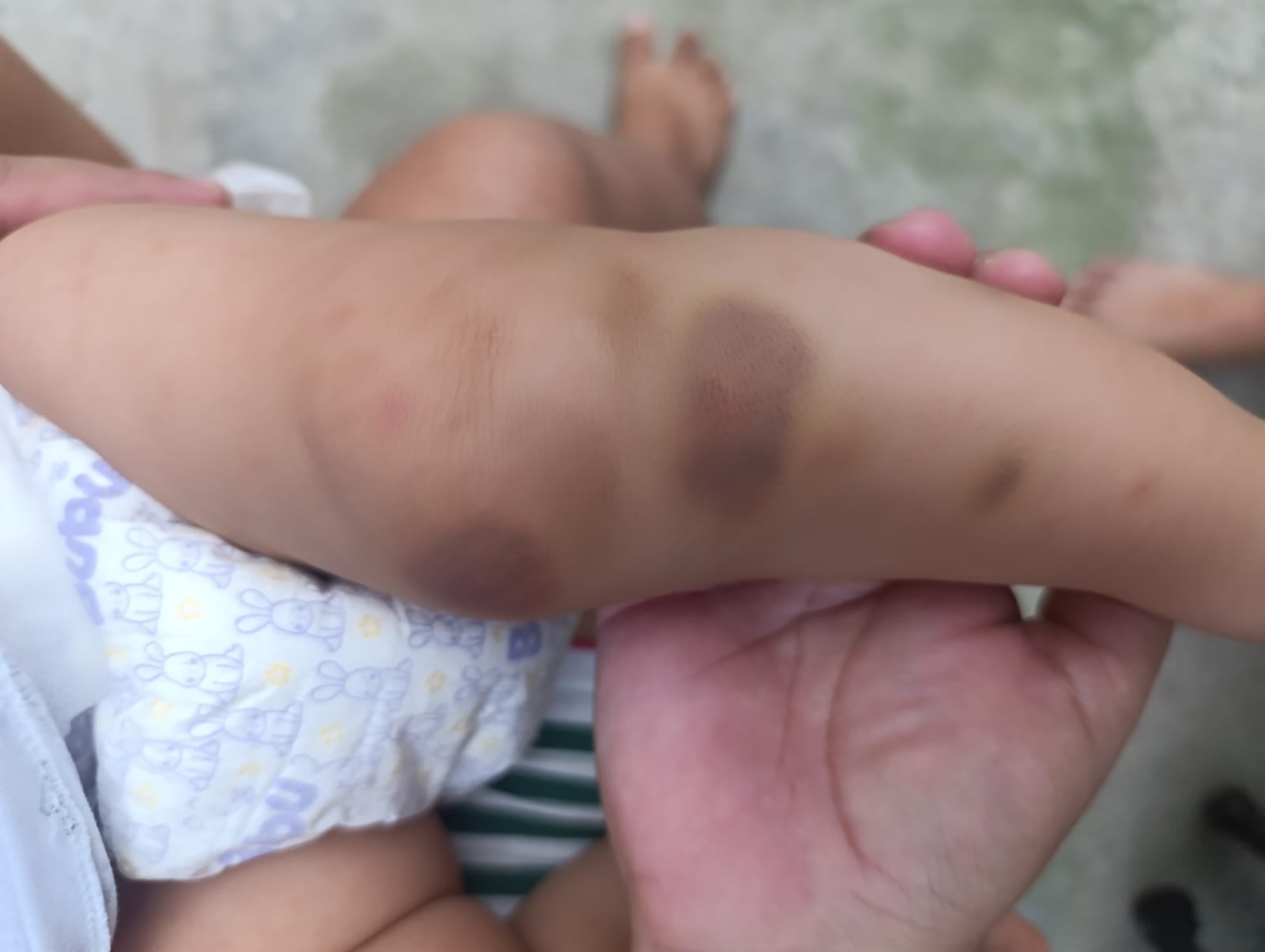 Hendrick Samuel tiene 17 meses y padece hemofilia A severa. Fue diagnosticado a los cuatro meses y no recibía su medicamento desde diciembre de 2025.