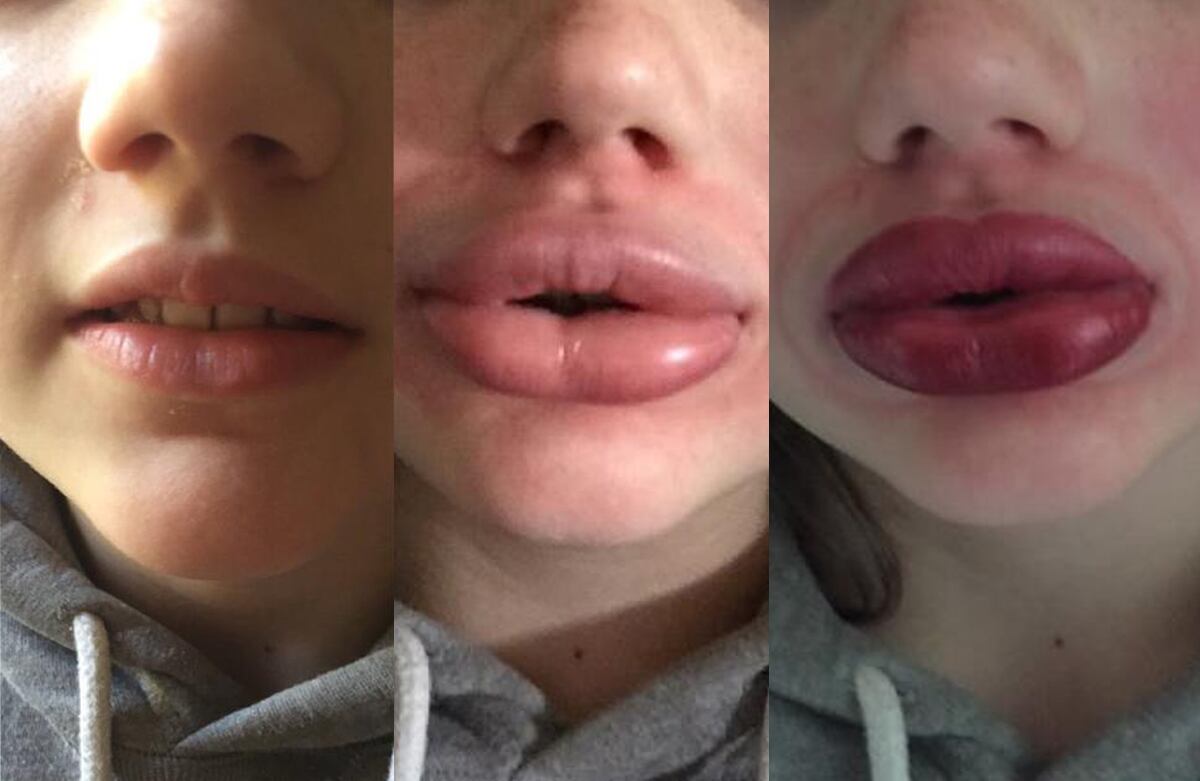 Esta joven muestra el cambio de sus labios e incluso se los pinta de rojo.