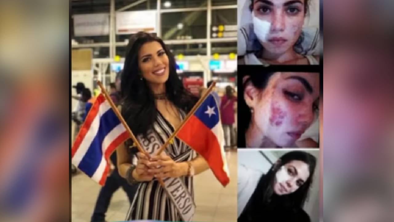 Andrea Díaz mostró las secuelas que le dejó un mal procedimiento estético. Foto: captura de pantalla canal de Youtube Beauty.