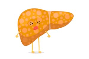 El hígado graso es una condición que se produce cuando los ácidos grasos y triglicéridos se retienen de forma excesiva en las células hepáticas.