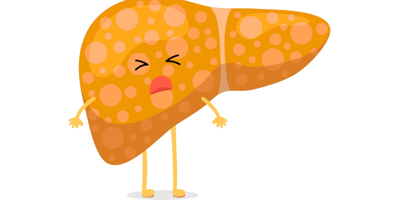 El hígado graso es una condición que se produce cuando los ácidos grasos y triglicéridos se retienen de forma excesiva en las células hepáticas.