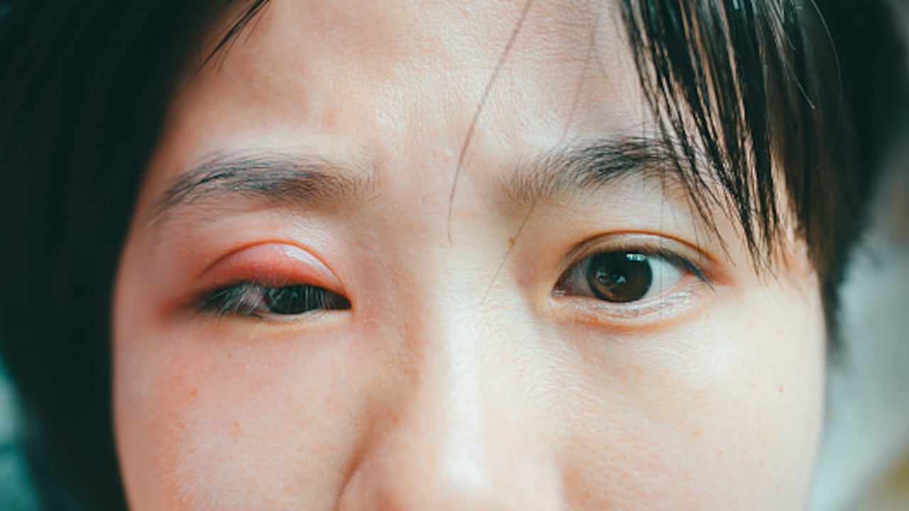 Comunmente, los párpados hinchados se relacionan con la blefaritis.